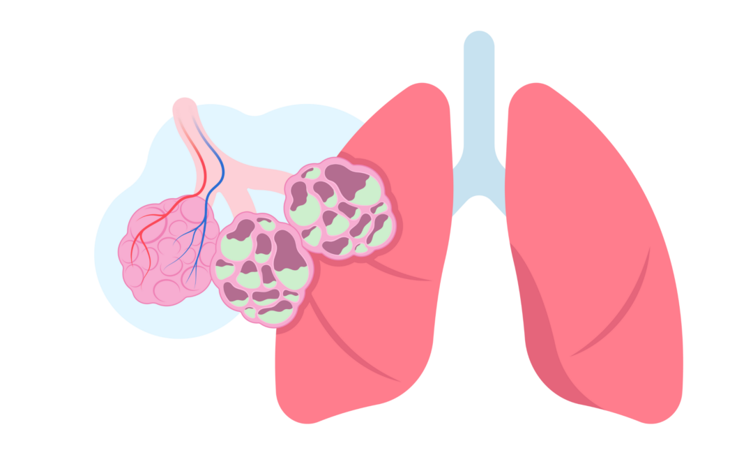 De preventie van bronchiolitis bij zuigelingen