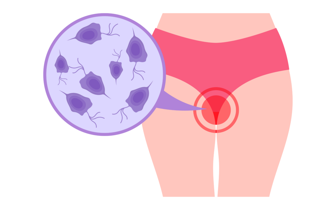 Vaginale mycosen: meer weerstand tegen azolen